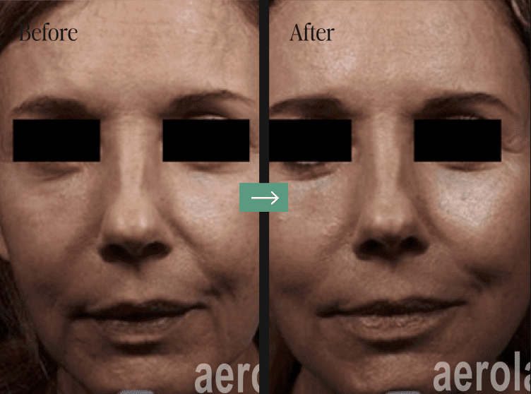 Aerolase Laser Before and After Pictures Charleston County, SC